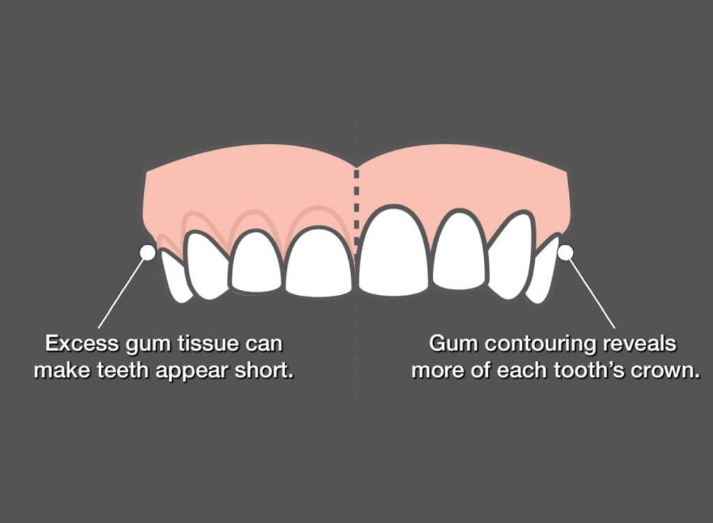 Gum Contouring