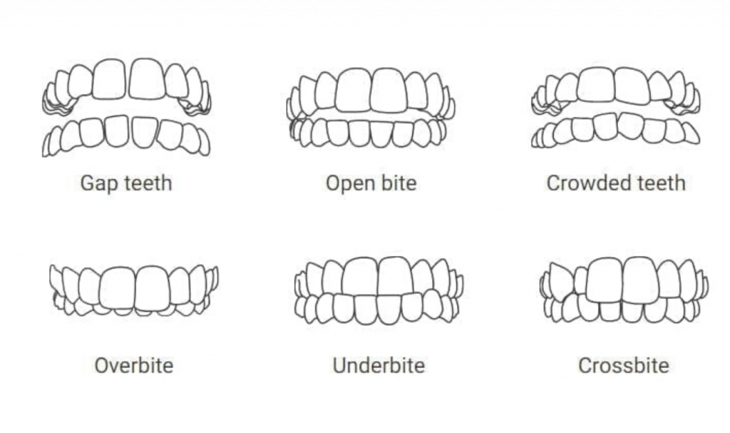 Crooked Teeth Diagram